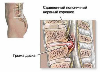 Hernia or protrusion of the intervertebral disc, protruding towards the spinal canal and compressing the nerve root.